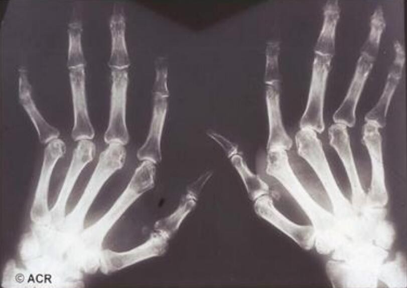 蜂王漿治療風濕，有風濕能吃蜂蜜和蜂王漿嗎?